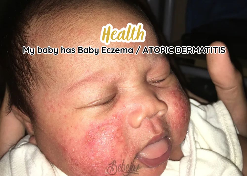 My baby has Infantile Eczema (Atopic Dermatitis) with video and photos