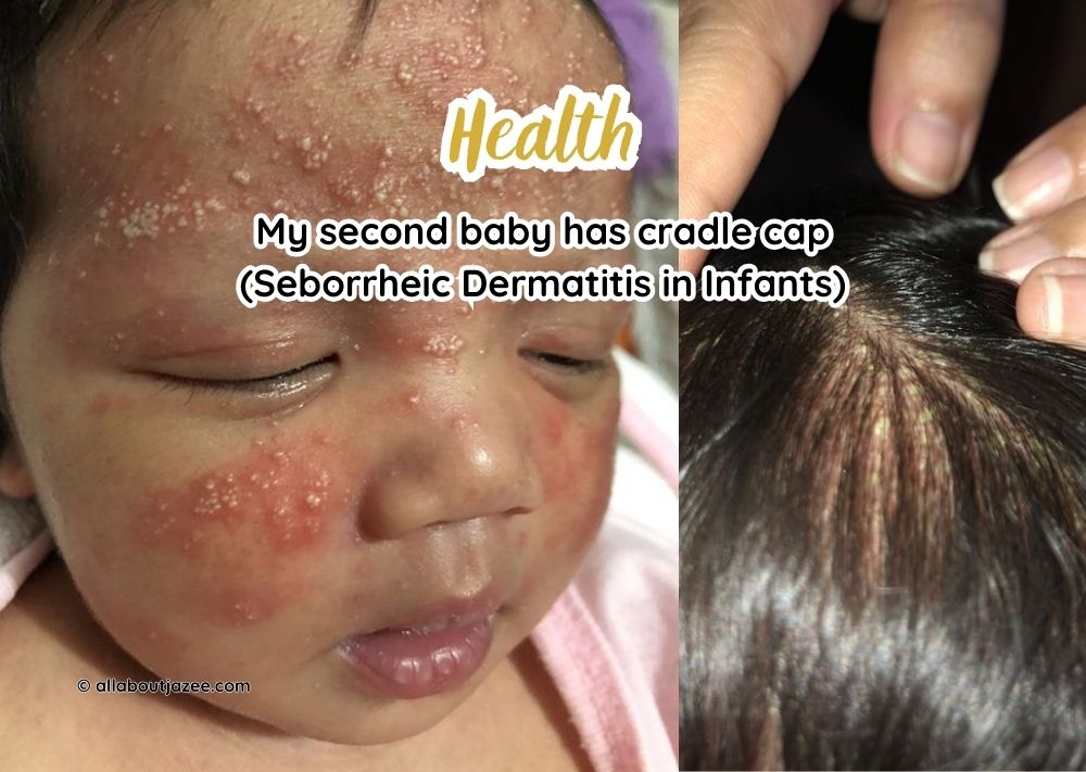 My second baby has cradle cap (Seborrheic Dermatitis in Infants) with video and photos